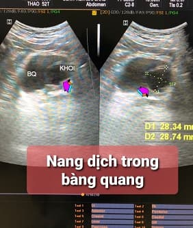 Bí đái, đái khó do nang tuyến tiền liệt