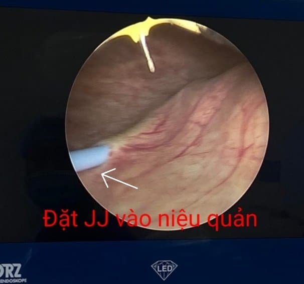 Phẫu thuật nội soi ngược dòng bóc khối u dưới niêm mạc bàng quang