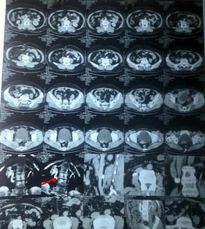 Phẫu thuật nội soi sau phúc mạc tạo hình niệu quản sau tĩnh mạch chủ dưới ( Retrocaval ureter, Laparoscpic Extraperitoneal)