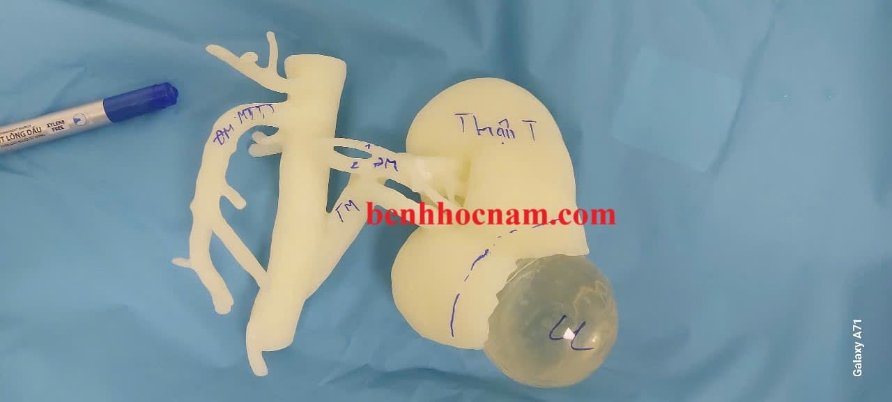 KẾT QUẢ BƯỚC ĐẦU PHẪU THUẬT NỘI SOI ĐIỀU TRỊ U THẬN SỬ DỤNG MÔ HÌNH IN 3D TẠI BỆNH VIỆN E TỪ 2021 ĐẾN 2024