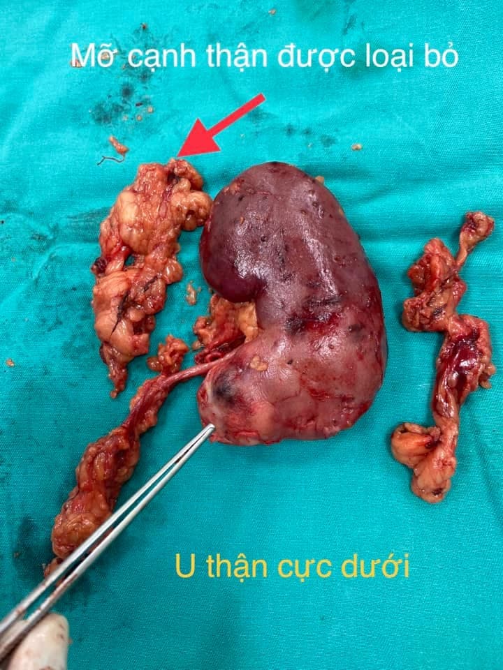 Phẫu thuật nội soi cắt thận do ung thư đường sau phúc mạc