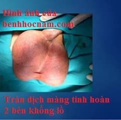 Phẫu thuật tràn dịch màng tinh hoàn ở người lớn bằng đường mổ nhỏ