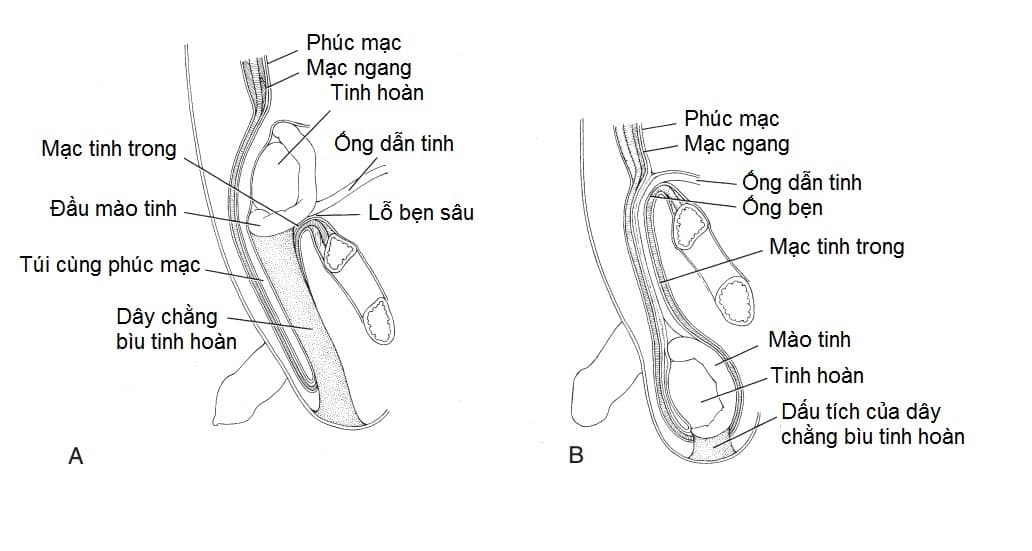 Các dị tật vùng bẹn bìu thường gặp ở trẻ em
