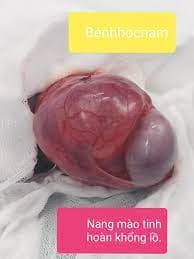 Một số phẫu thuật điều trị bệnh lý ở tinh hoàn