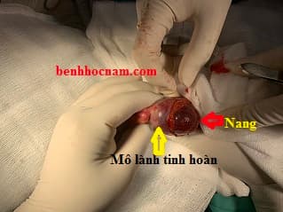 Nang nước tinh hoàn - Simple intratesticular cysts