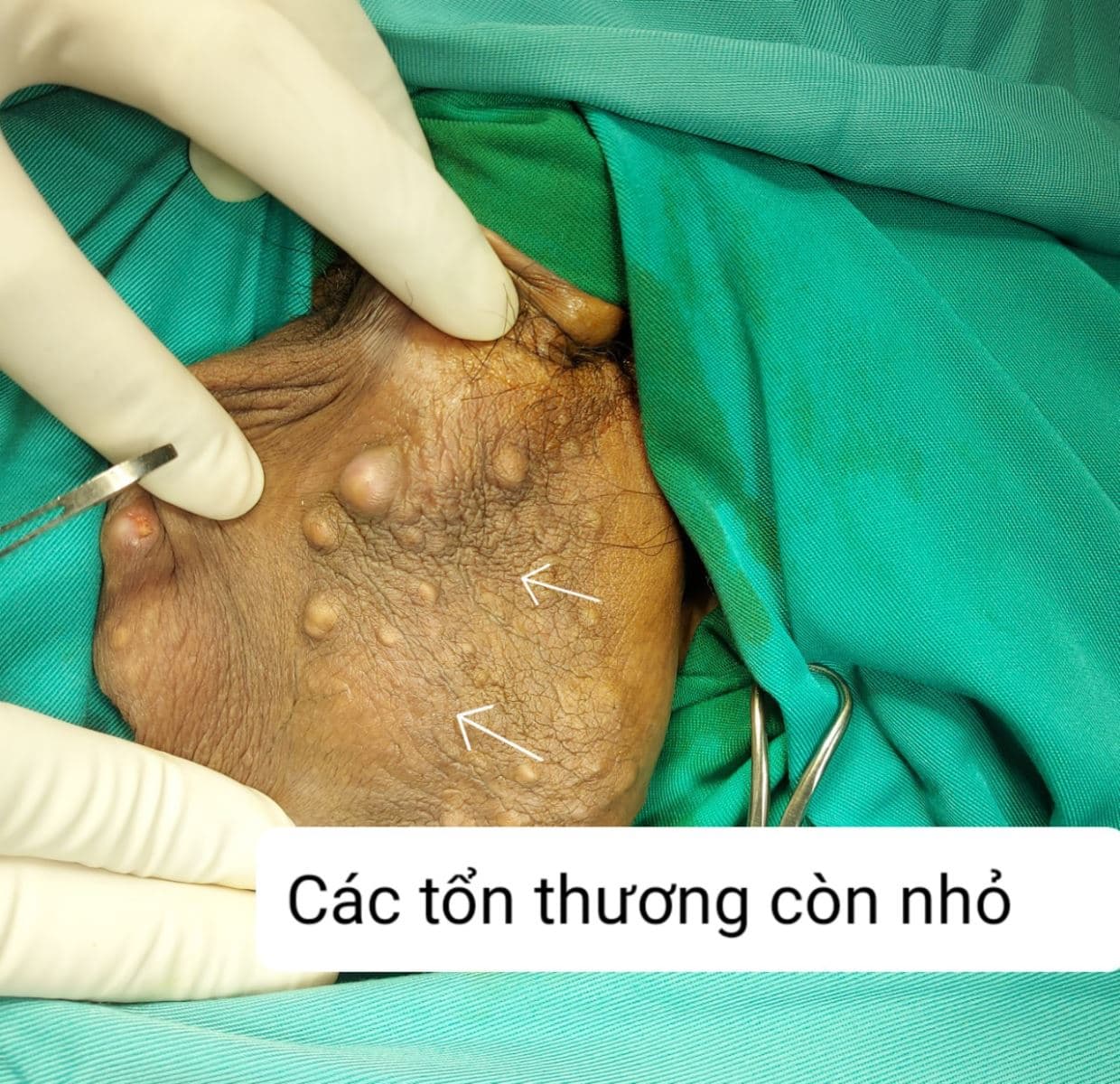 Phẫu thuật bóc đa u nang tuyến bã ở da bìu (sebaceous cyst)