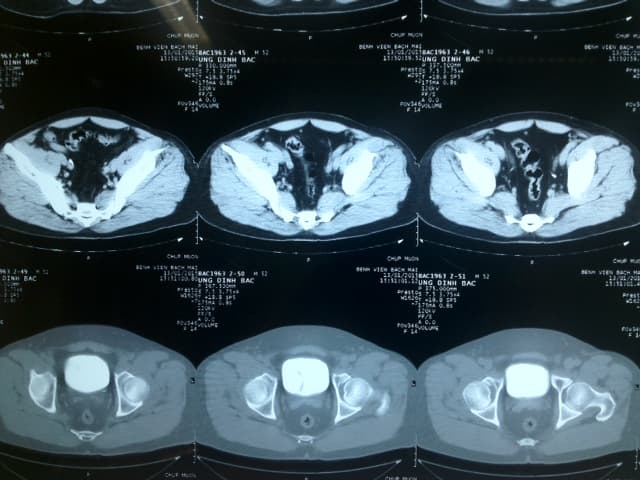 Chẩn đoán và điều trị sớm polyp bàng quang