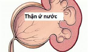 Đặt lịch phẫu thuật nội soi cắt thận mất chức năng do sỏi niệu quản