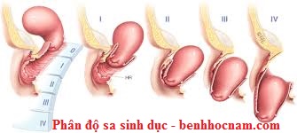 Các hình ảnh sa sinh dục ở nữ giới