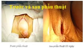 hình ảnh trước và sau phẫu thuật sa sinh dục