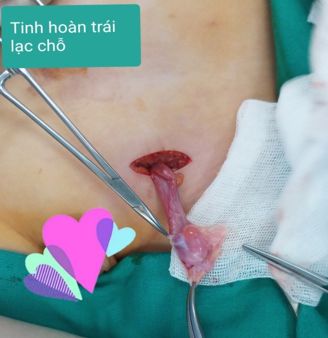 Tinh hoàn lạc chỗ bên trái