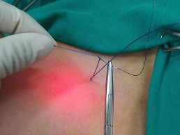 Thay chỉ Vicryl bằng PDS/benhhocnam.com