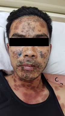 Hoại tử thượng bì - Trước điều trị