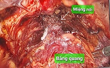 Khâu nối niệu đạo - cổ bàng quang/benhhocnam.com