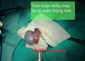 Xoắn thừng tinh hoàn 1/benhhocnam.com
