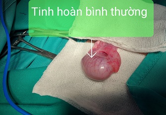 Tinh hoàn bình thường/benhhocnam.com