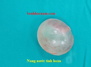 Nang nước tinh hoàn/benhhocnam.com