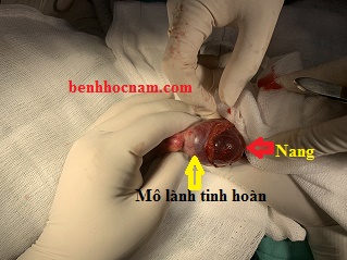 Bóc nang nước thừng tinh/benhhocnam.com