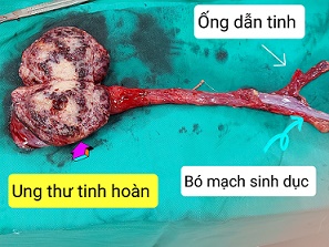 Ung thư tinh hoàn 2/benhhocnam.com