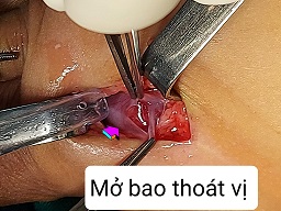 Mở bao thoát vị bẹn/benhhocnam.com