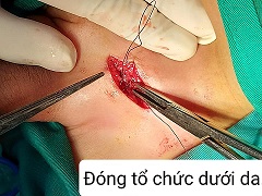 Khâu tổ chức dưới da/benhhocnam.com