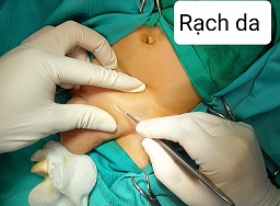 Rạch da/benhhocnam.com