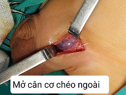 Mở cân chéo ngoài/benhhocnam.com