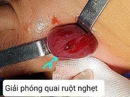 Giải phóng nội dung thoát vị bẹn/benhhocnam.com