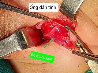 Ống dẫn tinh và mạch sinh dục/benhhocnnam.com