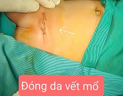 Khâu thẩm mỹ đóng da vết mổ/benhhocnnam.com