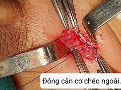 Khâu cân chéo bụng ngoài/benhhocnam.com