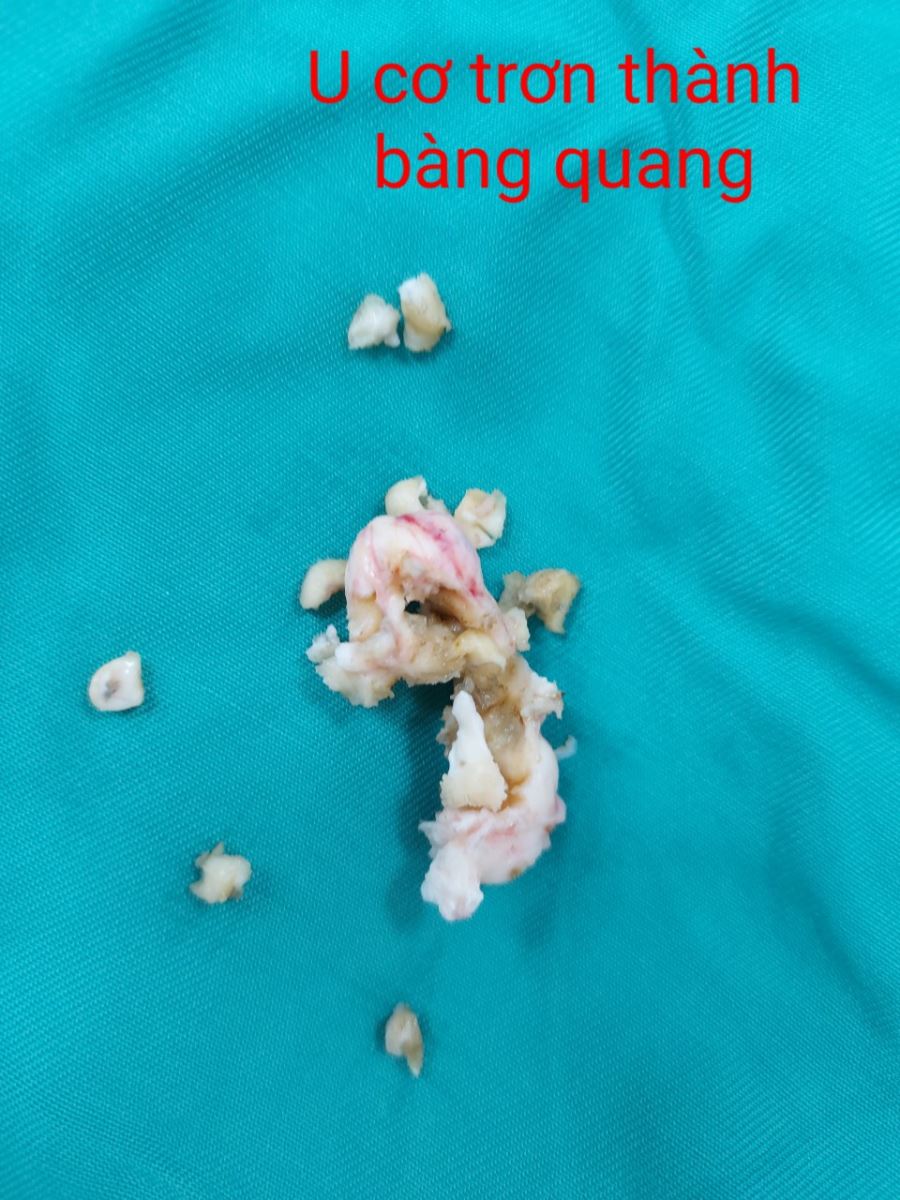 Tổ chức u của thành bàng quang/benhhocnam.com
