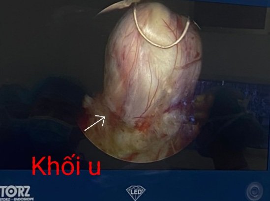 Khối u cơ trơn thành bàng quang/benhhocnam.com