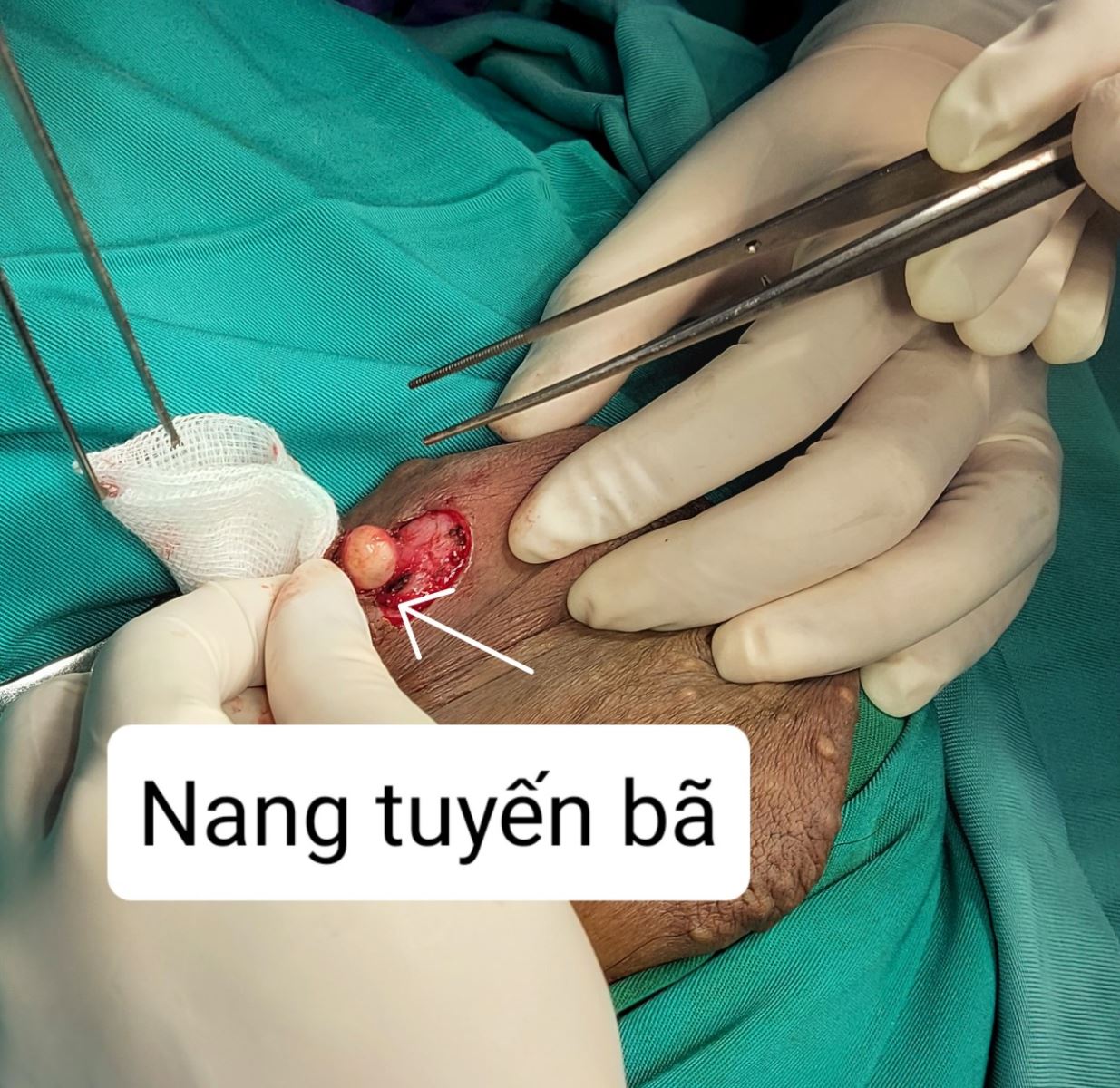 Khối nang tuyến bã/benhhocnam.com