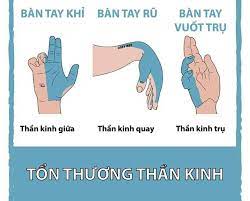 Tổn thương các dây thần kinh/benhhocnam.com