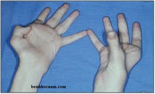 Bàn tay vuốt trụ/benhhocnam.com