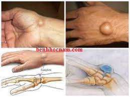 Nổi u cục ở cổ bàn tay