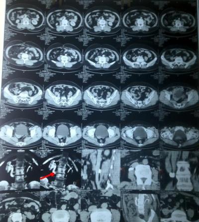 niệu quản sau tĩnh mạch chủ dưới ( Retrocaval ureter)
